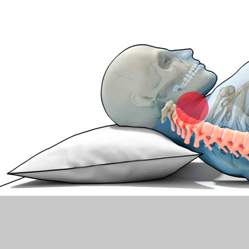 snurken, blokkade, luchtweg, houding, nek, hoofd, rugligging, advies, kalkman, beddenspeciaalzaak, bodegraven, beddenspecialist, apneu,