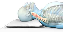 rugliging, onjuist, dun, te laagg, hoofdkussen, nekpijn, kalkman, bodegraven, beddenspeciaalzaak, beddenspecialist,